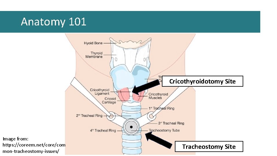 Anatomy 101 Cricothyroidotomy Site Image from: https: //coreem. net/core/com mon-tracheostomy-issues/ Tracheostomy Site Anatomy 101 Cricothyroidotomy Site Image from: https: //coreem. net/core/com mon-tracheostomy-issues/ Tracheostomy Site
