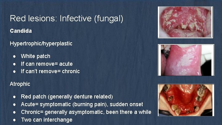 Red lesions: Infective (fungal) Candida Hypertrophic/hyperplastic ● White patch ● If can remove= acute