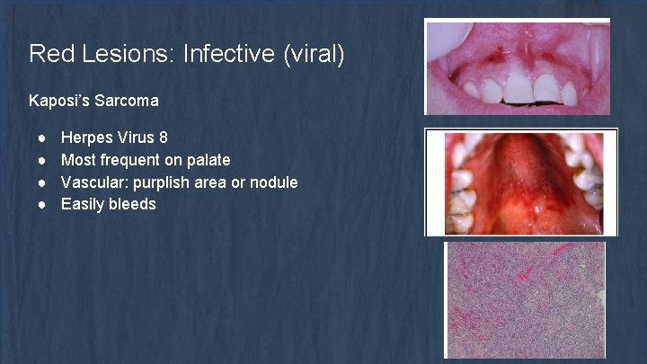 Red Lesions: Infective (viral) Kaposi’s Sarcoma ● ● Herpes Virus 8 Most frequent on