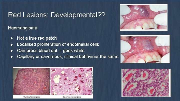 Red Lesions: Developmental? ? Haemangioma ● ● Not a true red patch Localised proliferation