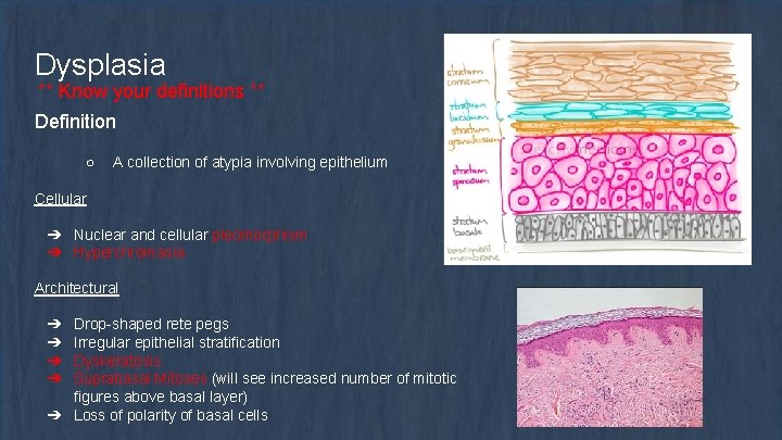 Dysplasia ** Know your definitions ** Definition ○ A collection of atypia involving epithelium