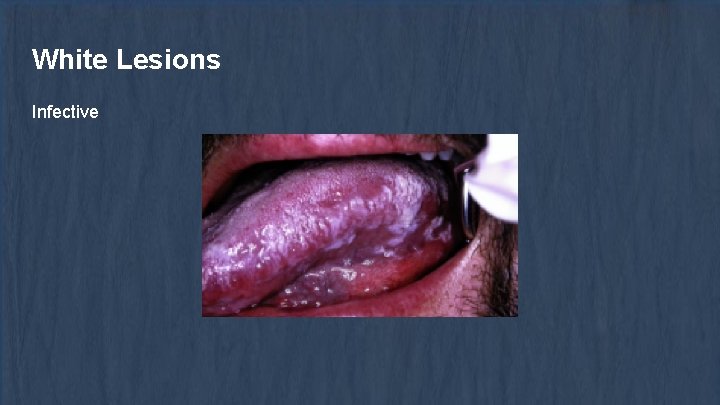 White Lesions Infective 