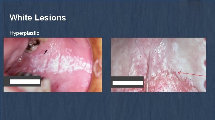 White Lesions Hyperplastic 