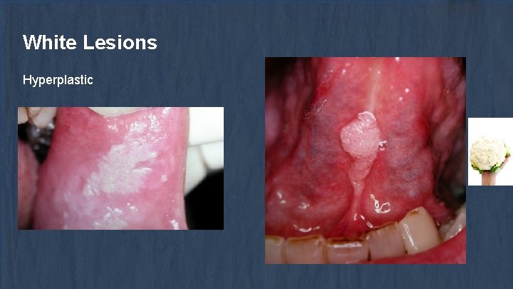 White Lesions Hyperplastic 