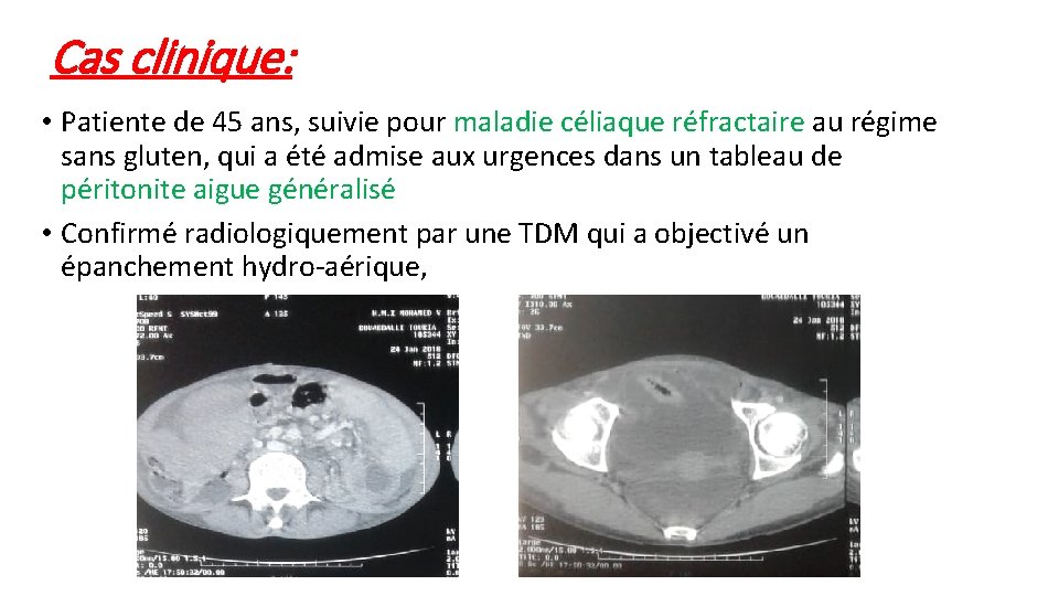 Cas clinique: • Patiente de 45 ans, suivie pour maladie céliaque réfractaire au régime