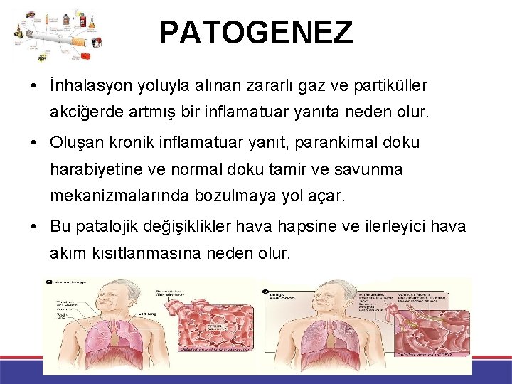 PATOGENEZ • İnhalasyon yoluyla alınan zararlı gaz ve partiküller akciğerde artmış bir inflamatuar yanıta