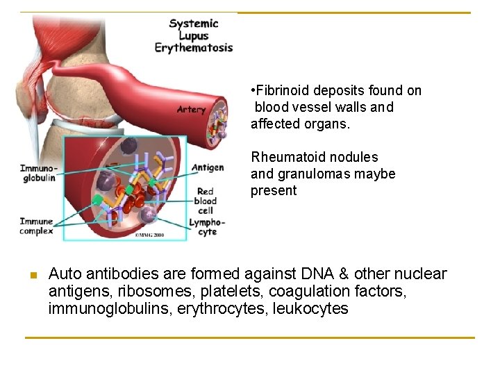  • Fibrinoid deposits found on blood vessel walls and affected organs. Rheumatoid nodules