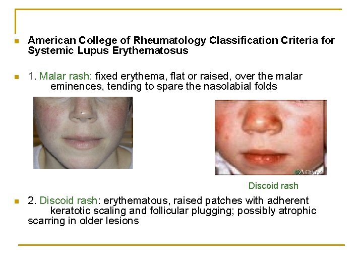 n American College of Rheumatology Classification Criteria for Systemic Lupus Erythematosus n 1. Malar