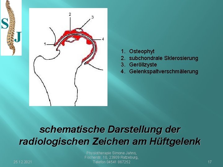 1. 2. 3. 4. Osteophyt subchondrale Sklerosierung Geröllzyste Gelenkspaltverschmälerung schematische Darstellung der radiologischen Zeichen