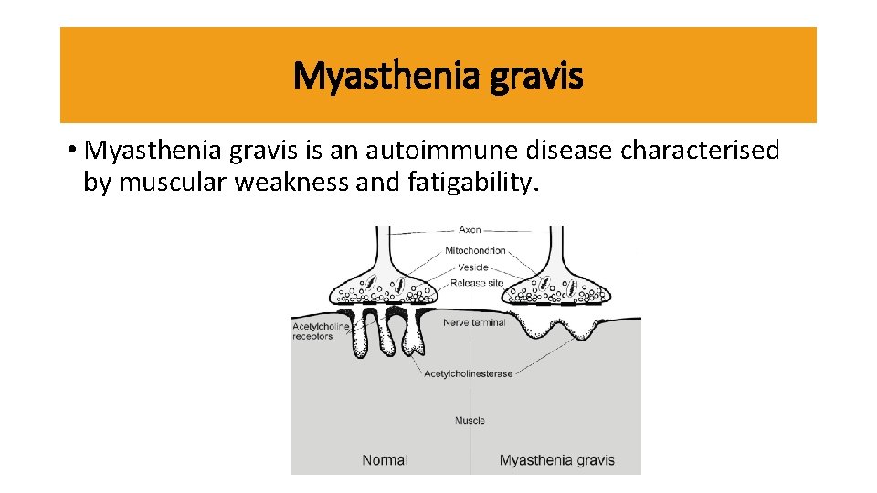 Myasthenia gravis • Myasthenia gravis is an autoimmune disease characterised by muscular weakness and