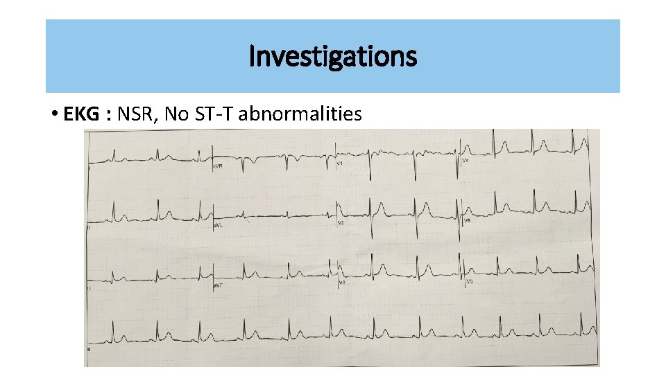Investigations • EKG : NSR, No ST-T abnormalities 