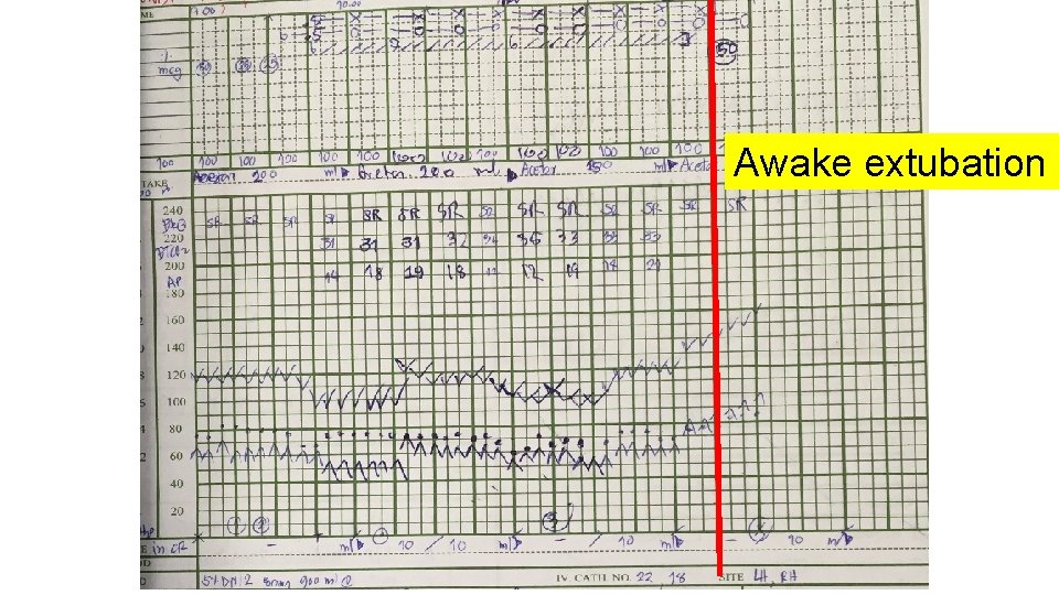 Awake extubation 