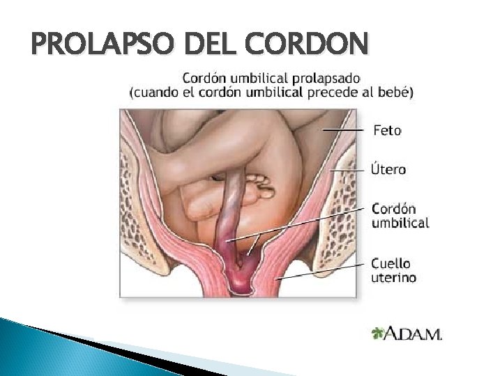 PROLAPSO DEL CORDON 