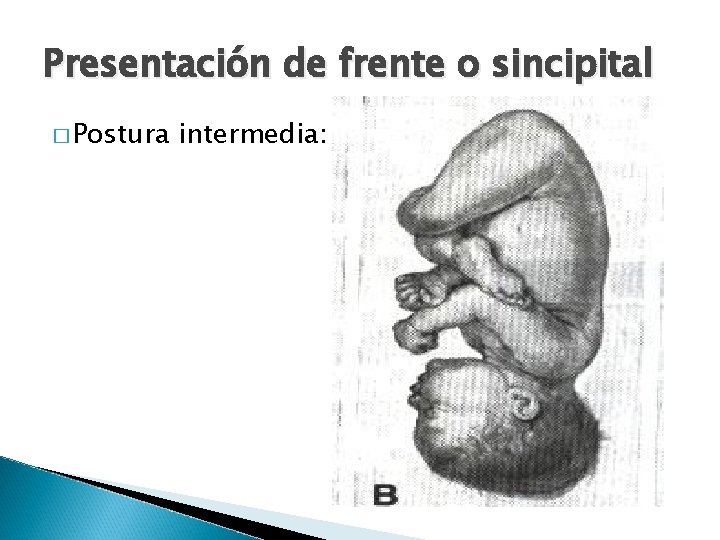 Presentación de frente o sincipital � Postura intermedia: 