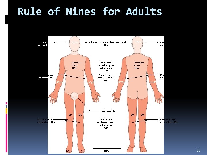 Rule of Nines for Adults 41/2% Anterior and posterior head and neck 9% 41/2%