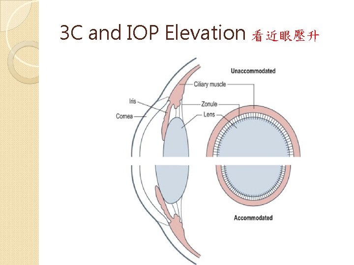 3 C and IOP Elevation 看近眼壓升 