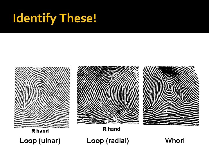 Identify These! R hand Loop (ulnar) R hand Loop (radial) Whorl 