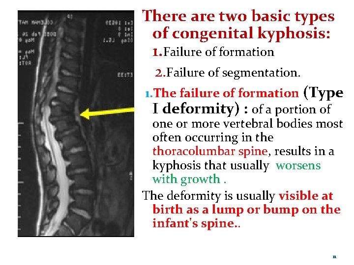 There are two basic types of congenital kyphosis: 1. Failure of formation 2. Failure