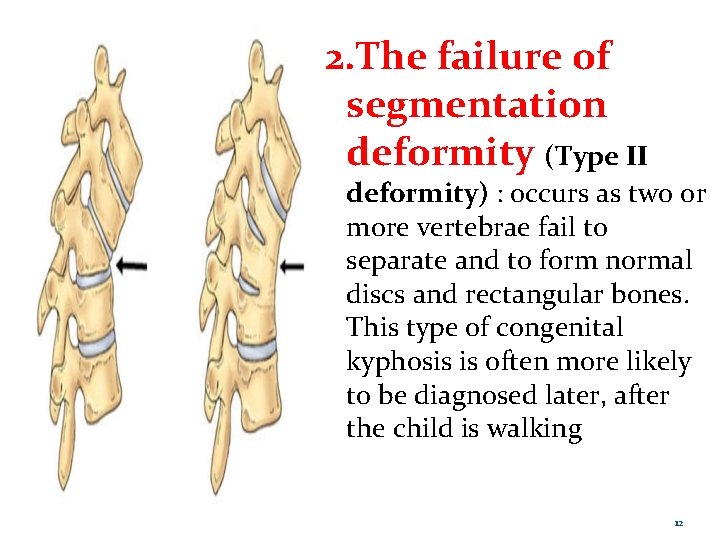 2. The failure of segmentation deformity (Type II deformity) : occurs as two or