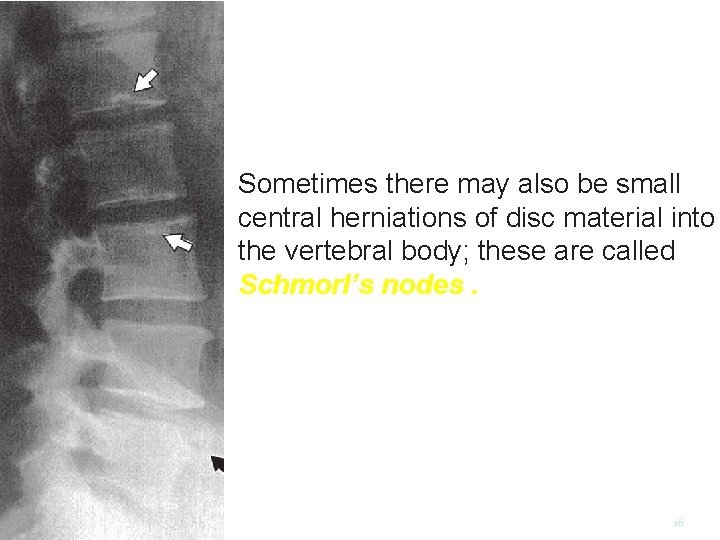 Sometimes there may also be small central herniations of disc material into the vertebral