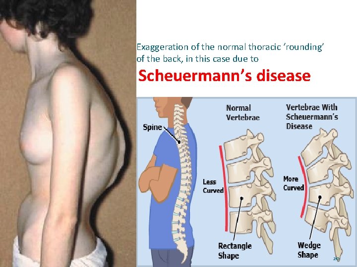 Exaggeration of the normal thoracic ‘rounding’ of the back, in this case due to