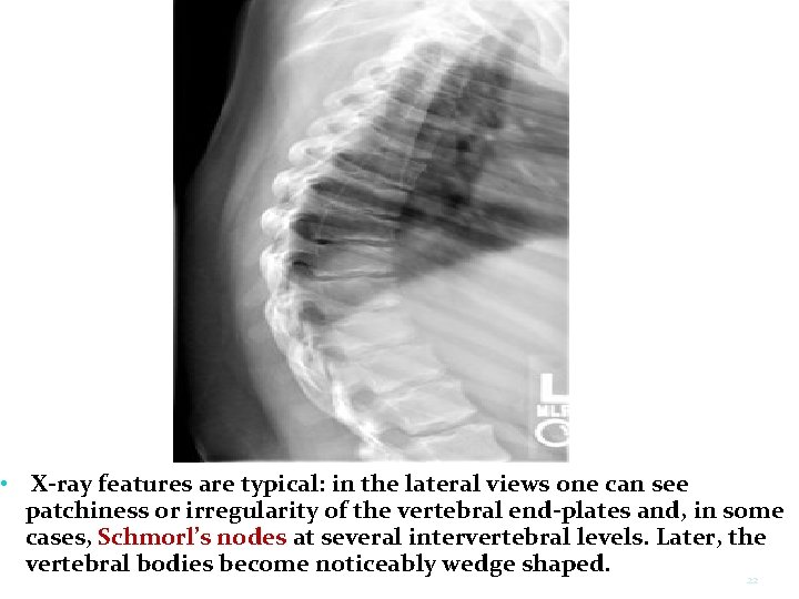  • X-ray features are typical: in the lateral views one can see patchiness
