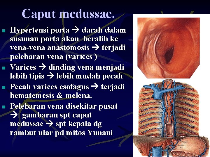 Caput medussae. n n Hypertensi porta darah dalam susunan porta akan beralih ke vena-vena