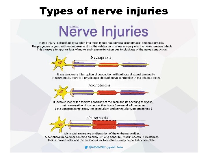 Types of nerve injuries Types of nerve injuries