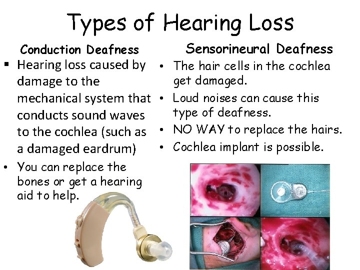 Types of Hearing Loss Conduction Deafness § Hearing loss caused by damage to the