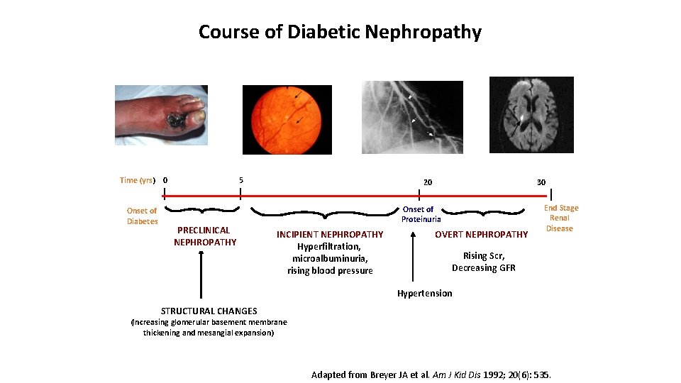 Course of Diabetic Nephropathy Time (yrs) 0 Onset of Diabetes 5 PRECLINICAL NEPHROPATHY 20