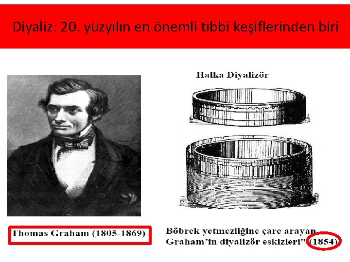 Diyaliz: 20. yüzyılın en önemli tıbbi keşiflerinden biri 