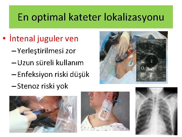 En optimal kateter lokalizasyonu • İntenal juguler ven – Yerleştirilmesi zor – Uzun süreli