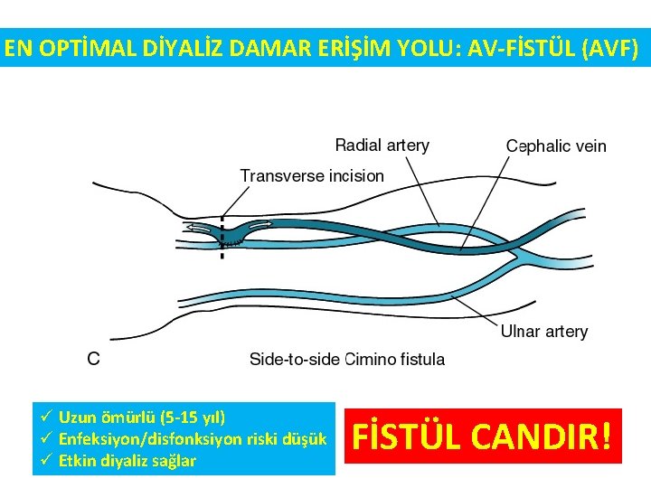 EN OPTİMAL DİYALİZ DAMAR ERİŞİM YOLU: AV-FİSTÜL (AVF) ü Uzun ömürlü (5 -15 yıl)