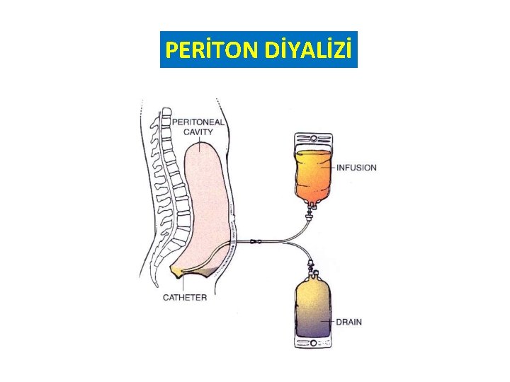 PERİTON DİYALİZİ 