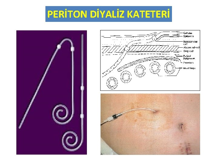 PERİTON DİYALİZ KATETERİ 