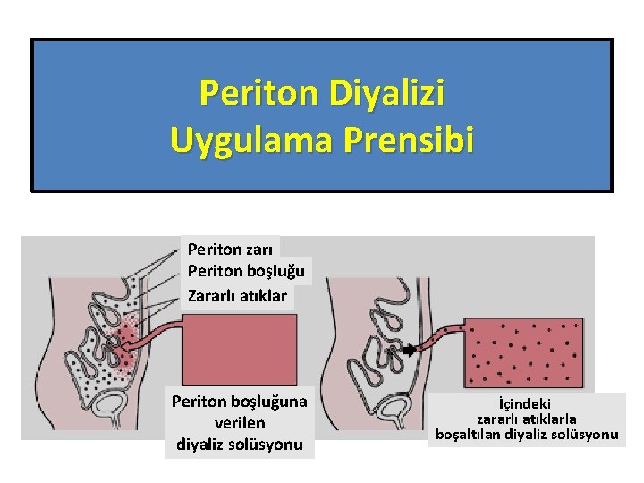 Periton Diyalizi Uygulama Prensibi Periton zarı Periton boşluğu Zararlı atıklar Periton boşluğuna verilen diyaliz