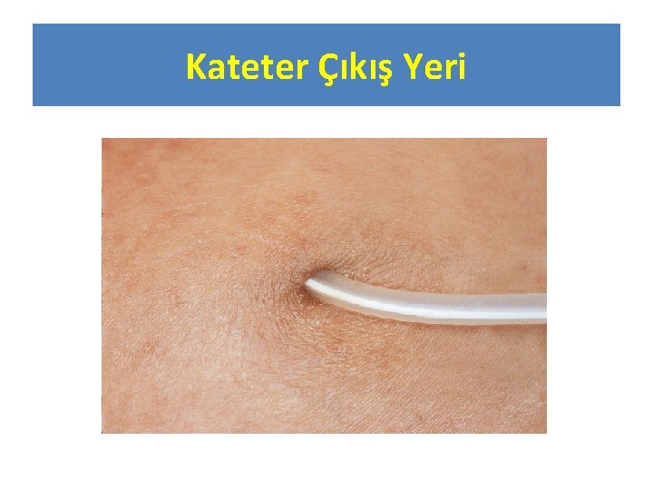 Kateter Çıkış Yeri 