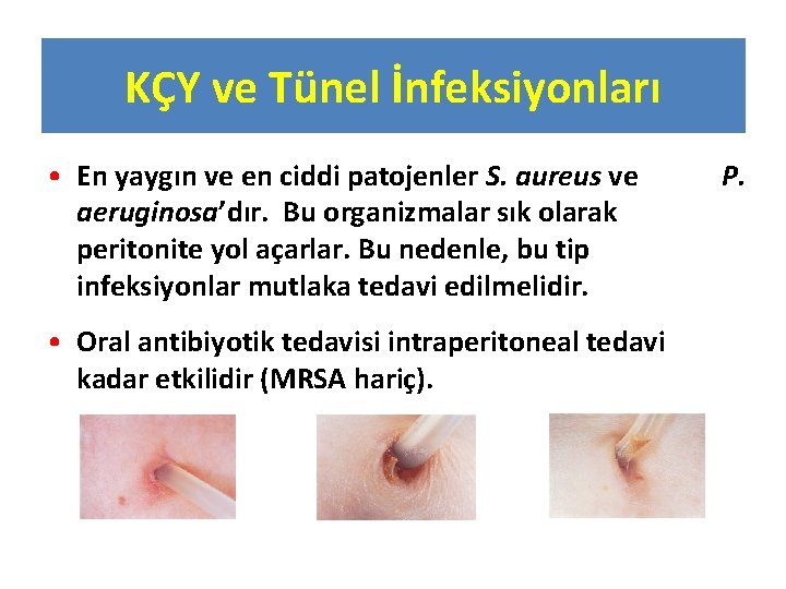 KÇY ve Tünel İnfeksiyonları • En yaygın ve en ciddi patojenler S. aureus ve