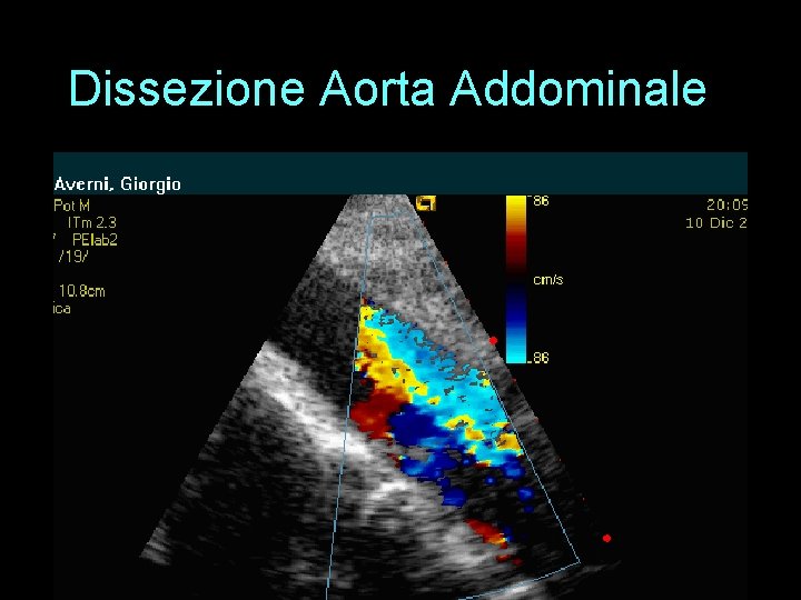 Dissezione Aorta Addominale 