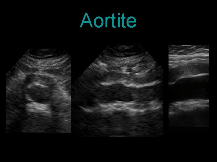 Aortite 