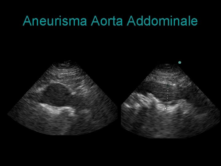 Aneurisma Aorta Addominale 