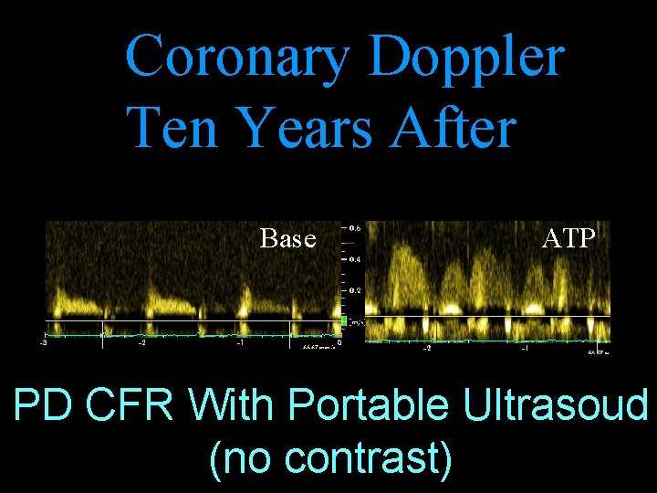 Coronary Doppler Ten Years After Base ATP PD CFR With Portable Ultrasoud (no contrast)