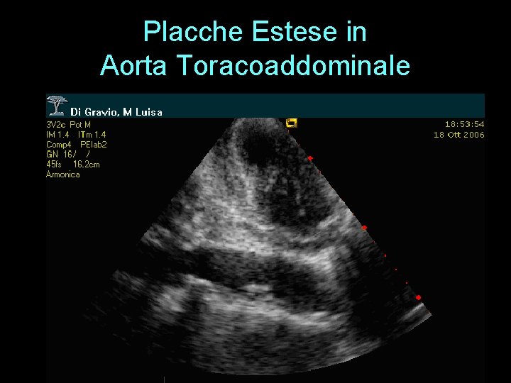 Placche Estese in Aorta Toracoaddominale 