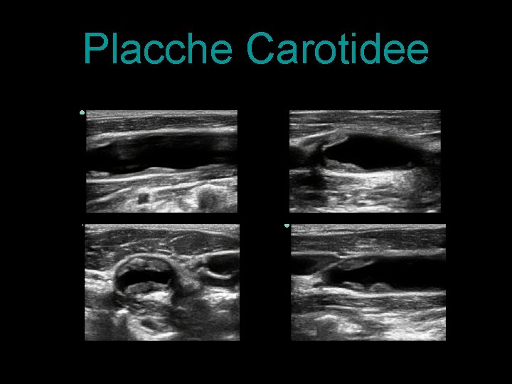 Placche Carotidee 