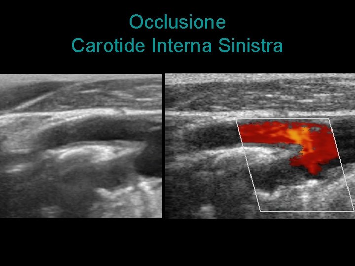 Occlusione Carotide Interna Sinistra 