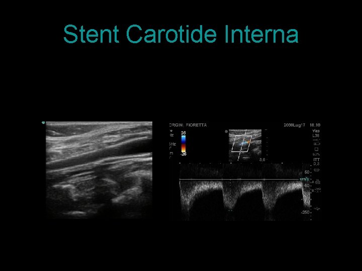 Stent Carotide Interna 