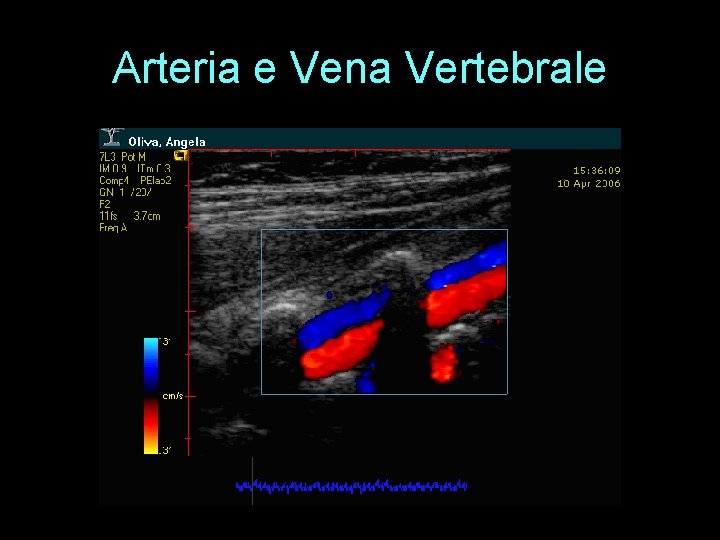 Arteria e Vena Vertebrale 