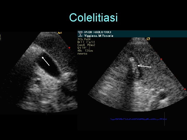 Colelitiasi 