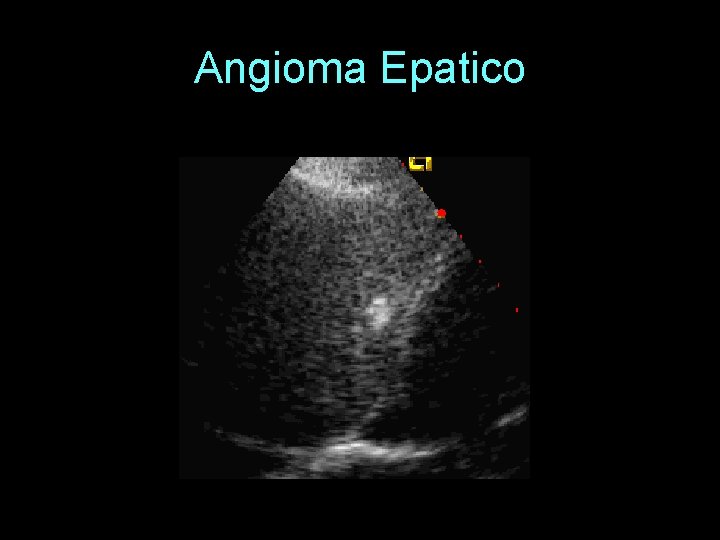 Angioma Epatico 