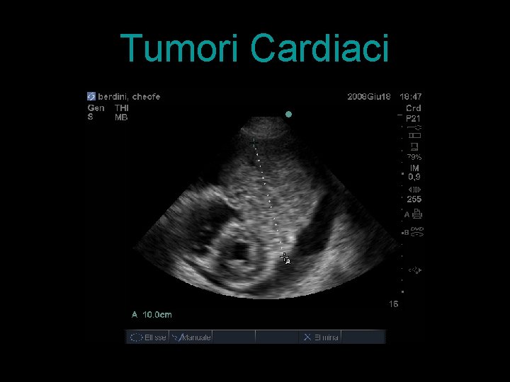 Tumori Cardiaci 